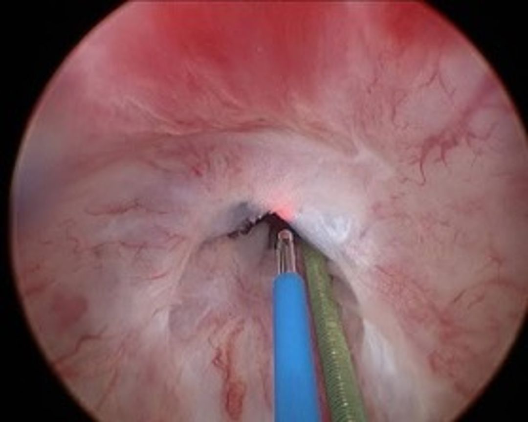 Endoskopik internal uretrotomiya (EİU)
